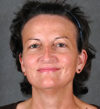 rhinoplasty - patient 5959 - after 1 rhinoplasty - patient 5959 - after 1