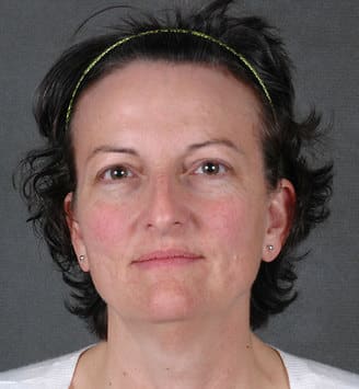 rhinoplasty - patient 5959 - before 1 rhinoplasty - patient 5959 - before 1