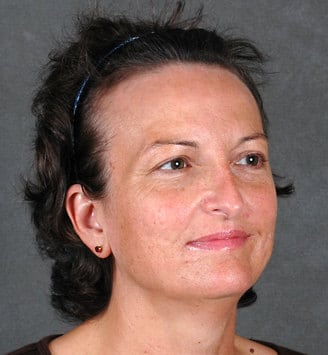 rhinoplasty - patient 5959 - after 2 rhinoplasty - patient 5959 - after 2