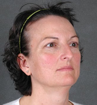 rhinoplasty - patient 5959 - before 2 rhinoplasty - patient 5959 - before 2