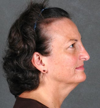 rhinoplasty - patient 5959 - after 3 rhinoplasty - patient 5959 - after 3