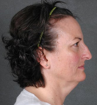 rhinoplasty - patient 5959 - before 3 rhinoplasty - patient 5959 - before 3