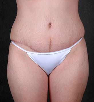 tummy tuck - patient 5022 - after 1 tummy tuck - patient 5022 - after 1
