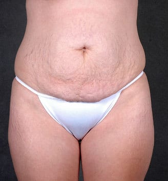 tummy tuck - patient 5022 - before 1 tummy tuck - patient 5022 - before 1