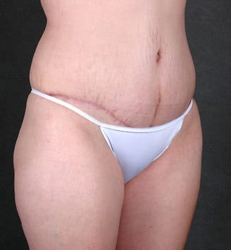 tummy tuck - patient 5022 - after 2 tummy tuck - patient 5022 - after 2