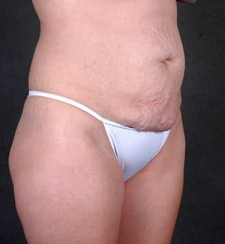 tummy tuck - patient 5022 - before 2 tummy tuck - patient 5022 - before 2