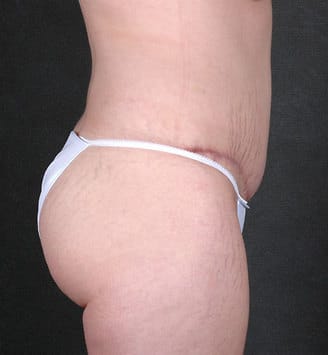 tummy tuck - patient 5022 - after 3 tummy tuck - patient 5022 - after 3