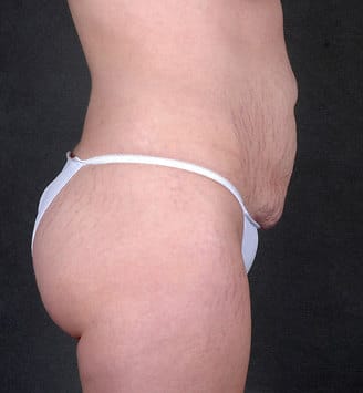 tummy tuck - patient 5022 - before 3 tummy tuck - patient 5022 - before 3