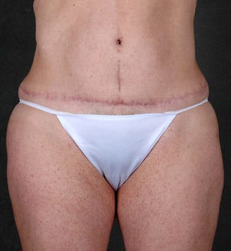 tummy tuck - patient 4912 - after 1 tummy tuck - patient 4912 - after 1