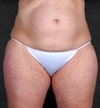 tummy tuck - patient 4912 - before 1 tummy tuck - patient 4912 - before 1