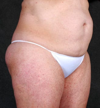 tummy tuck - patient 4912 - before 2 tummy tuck - patient 4912 - before 2
