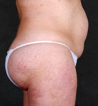 tummy tuck - patient 4912 - before 3 tummy tuck - patient 4912 - before 3