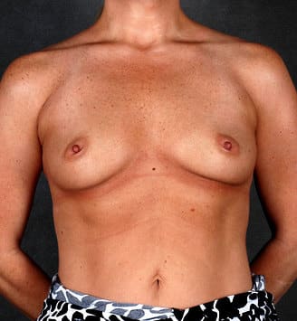 breast augmentation - patient 5208 - before 1 breast augmentation - patient 5208 - before 1