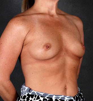 breast augmentation - patient 5208 - before 2 breast augmentation - patient 5208 - before 2