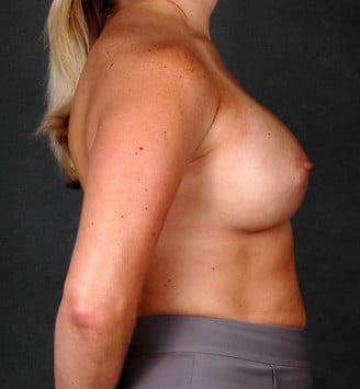 breast augmentation - patient 5208 - after 3 breast augmentation - patient 5208 - after 3