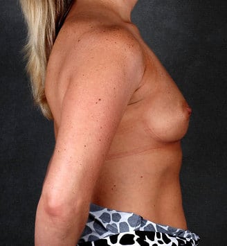 breast augmentation - patient 5208 - before 3 breast augmentation - patient 5208 - before 3