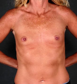 breast augmentation - patient 5021 - before 1 breast augmentation - patient 5021 - before 1