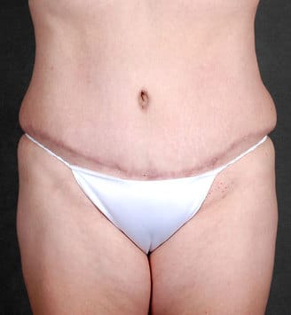 tummy tuck - patient 4865 - after 1 tummy tuck - patient 4865 - after 1