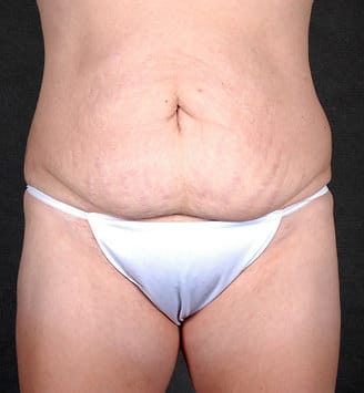 tummy tuck - patient 4865 - before 1 tummy tuck - patient 4865 - before 1