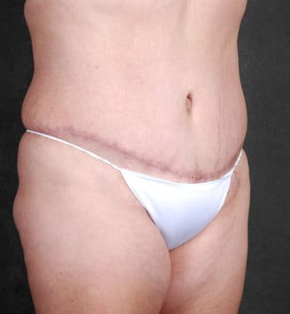 tummy tuck - patient 4865 - after 2 tummy tuck - patient 4865 - after 2