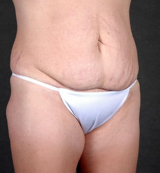 tummy tuck - patient 4865 - before 2 tummy tuck - patient 4865 - before 2