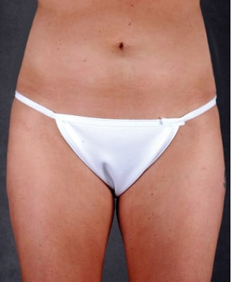 liposuction - patient 4039 - after 1 liposuction - patient 4039 - after 1