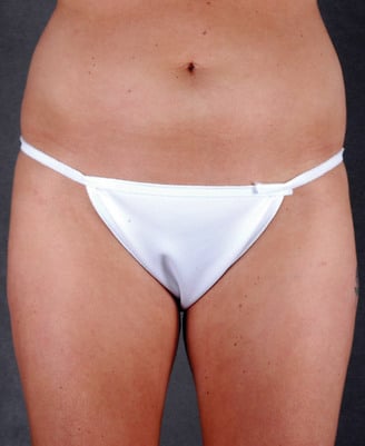 liposuction - patient 4039 - before 1 liposuction - patient 4039 - before 1