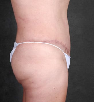 tummy tuck - patient 4865 - after 3 tummy tuck - patient 4865 - after 3