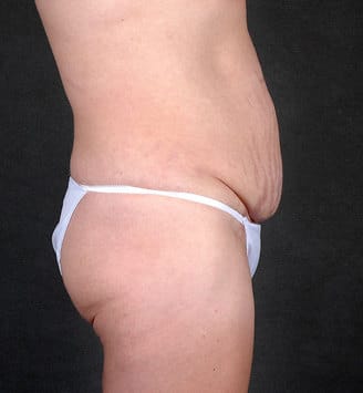 tummy tuck - patient 4865 - before 3 tummy tuck - patient 4865 - before 3