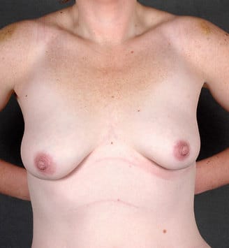 breast lift - patient 5870 - before 1 breast lift - patient 5870 - before 1