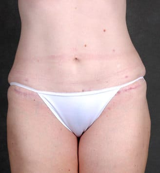 breast lift - patient 5870 - after 4 breast lift - patient 5870 - after 4