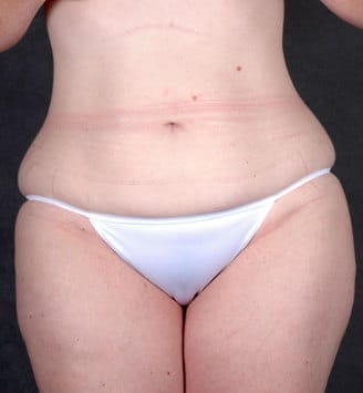 breast lift - patient 5870 - before 4 breast lift - patient 5870 - before 4