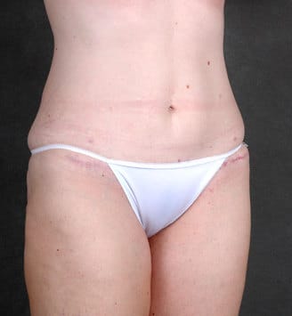 breast lift - patient 5870 - after 5 breast lift - patient 5870 - after 5