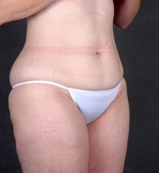 breast lift - patient 5870 - before 5 breast lift - patient 5870 - before 5