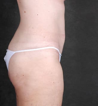 breast lift - patient 5870 - after 6 breast lift - patient 5870 - after 6
