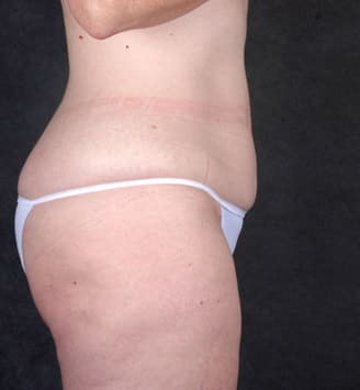 breast lift - patient 5870 - before 6 breast lift - patient 5870 - before 6