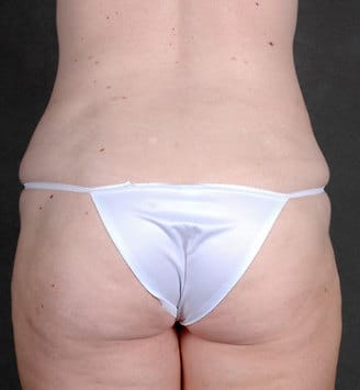 breast lift - patient 5870 - after 7 breast lift - patient 5870 - after 7