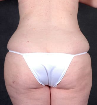breast lift - patient 5870 - before 7 breast lift - patient 5870 - before 7