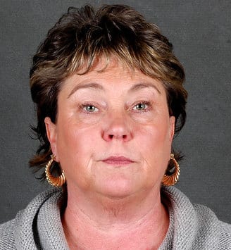 blepharoplasty - patient 5403 - before 1 blepharoplasty - patient 5403 - before 1
