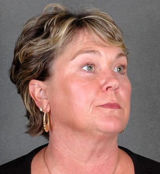 blepharoplasty - patient 5403 - after 2 blepharoplasty - patient 5403 - after 2