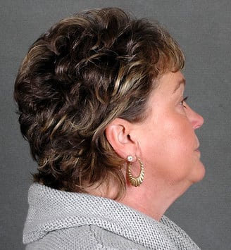 blepharoplasty - patient 5403 - before 3 blepharoplasty - patient 5403 - before 3