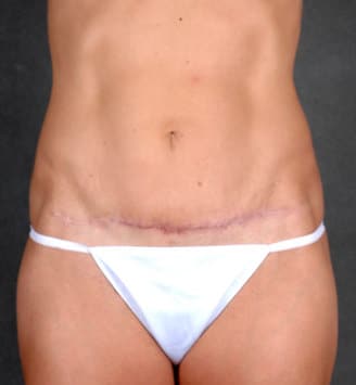 mommy makeover - patient 4600 - after 4 mommy makeover - patient 4600 - after 4