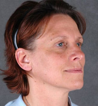 blepharoplasty - patient 5471 - after 2 blepharoplasty - patient 5471 - after 2