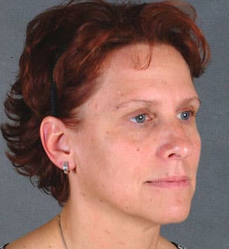 blepharoplasty - patient 5471 - before 2 blepharoplasty - patient 5471 - before 2
