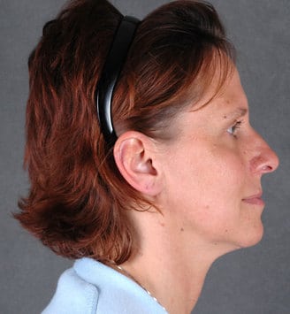 blepharoplasty - patient 5471 - after 3 blepharoplasty - patient 5471 - after 3