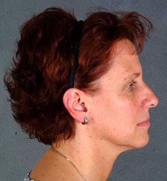 blepharoplasty - patient 5471 - before 3 blepharoplasty - patient 5471 - before 3