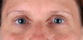 blepharoplasty - patient 5471 - after 4 blepharoplasty - patient 5471 - after 4