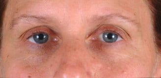 blepharoplasty - patient 5471 - before 4 blepharoplasty - patient 5471 - before 4