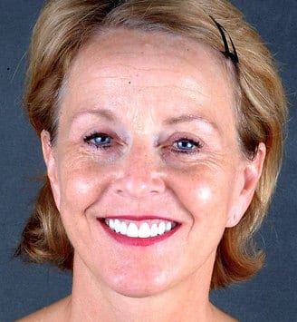 blepharoplasty - patient 5389 - after 1 blepharoplasty - patient 5389 - after 1
