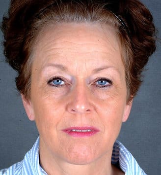 blepharoplasty - patient 5389 - before 1 blepharoplasty - patient 5389 - before 1